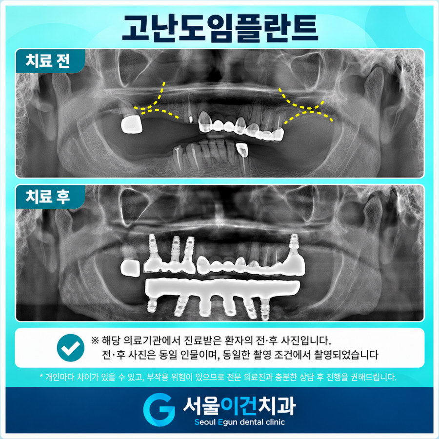 성인교정, 인비절라인